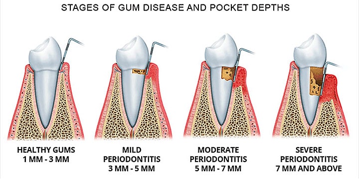 periodontitis